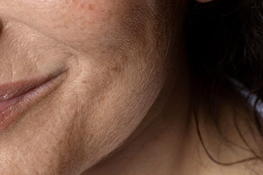 Melasma Treatment vs. Laser Scar Removal
