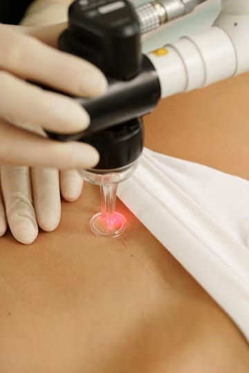 Melasma Treatment vs. Laser Scar Removal